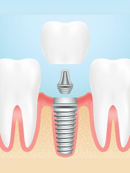 Dental Implants2 Dental Implants2