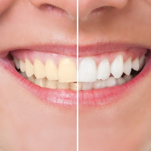 Teeth Whitening2
