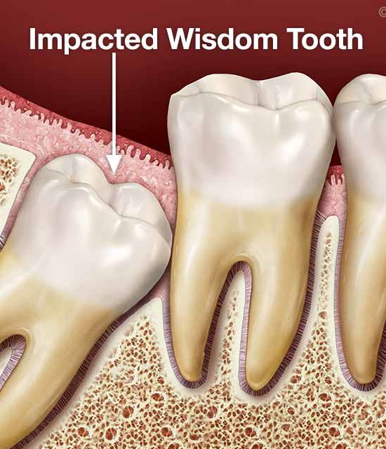 impacted-wisdom-tooth impacted-wisdom-tooth